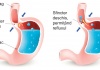 Refluxul gastroesofagian și insuficiența acidului gastric