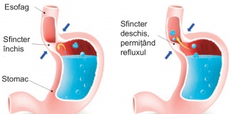 Refluxul gastroesofagian și insuficiența acidului gastric