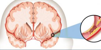 Nu numai vârstnicii pot avea accidente vasculare cerebrale
