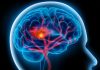 Șapte lucruri pe care le puteți face pentru a preveni un accident vascular cerebral
