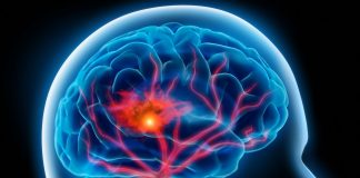 Șapte lucruri pe care le puteți face pentru a preveni un accident vascular cerebral