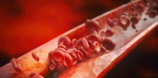 Relația dintre stres, accidente vasculare și infarct