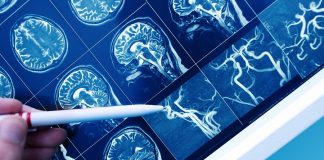 Trei metode pentru a evalua riscul de accident vascular cerebral și demență