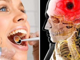 O sănătate orală precară ar putea duce la un risc crescut de accidente vasculare cerebrale