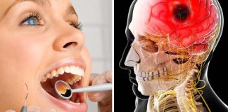O sănătate orală precară ar putea duce la un risc crescut de accidente vasculare cerebrale