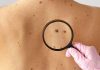 Melanomul cutanat, cel mai agresiv cancer de piele