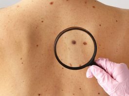 Melanomul cutanat, cel mai agresiv cancer de piele