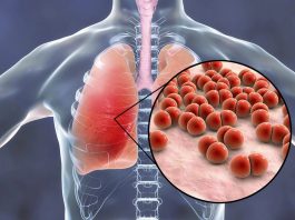 Infecțiile cu pneumococ: ce trebuie să știți?