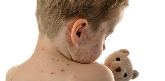 Rujeola: Simptome, transmitere și prevenție