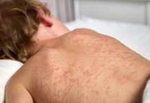 Rujeola face ravagii în Canada: cifre record în Ontario și Alberta
