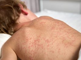 Rujeola face ravagii în Canada: cifre record în Ontario și Alberta