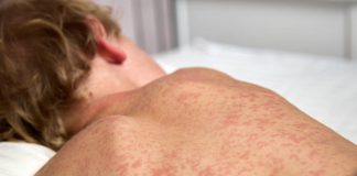 Rujeola face ravagii în Canada: cifre record în Ontario și Alberta